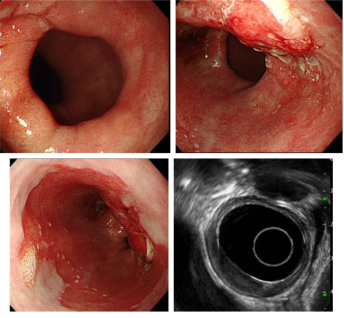 [그림 1] 내시경 검사 소견