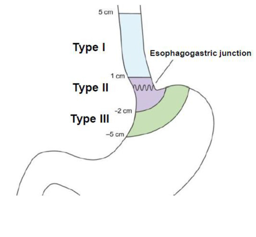 [그림 3] 위식도접합부암의 Siewert 분류