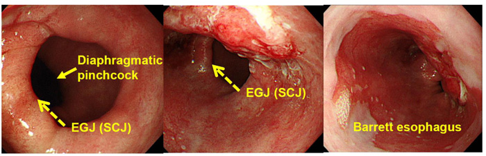 [그림 4] 본 증례의 내시경 사진으로 확인할 수 있는 위식도접합부 및 바렛식도