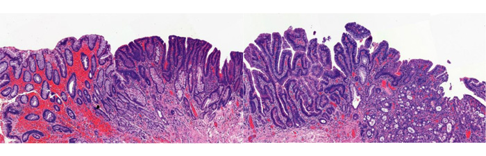 [그림 5] 본 증례의 수술 병리 소견: 왼쪽에서 오른쪽으로 바렛식도-이형성증-식도선암으로
의 진행을 확인할 수 있다.
