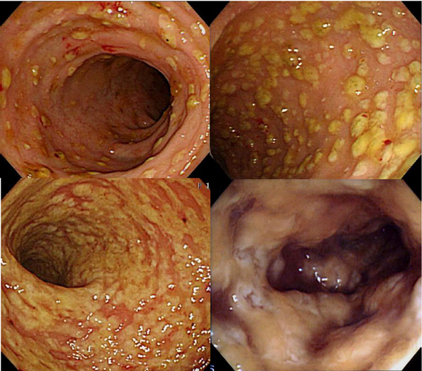 구불결장경에서 관찰되는 다양한 위막 대장염 소견