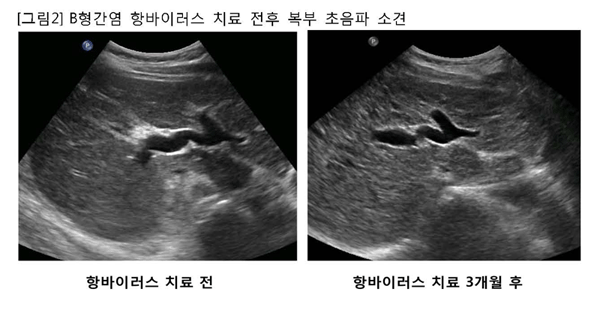 [그림2] B형간염 항바이러스 치료 전후 복부 초음파 소견